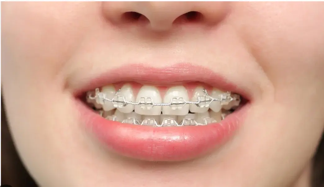 Teeth barces.webp