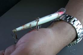 treble stuck in hand.jpg